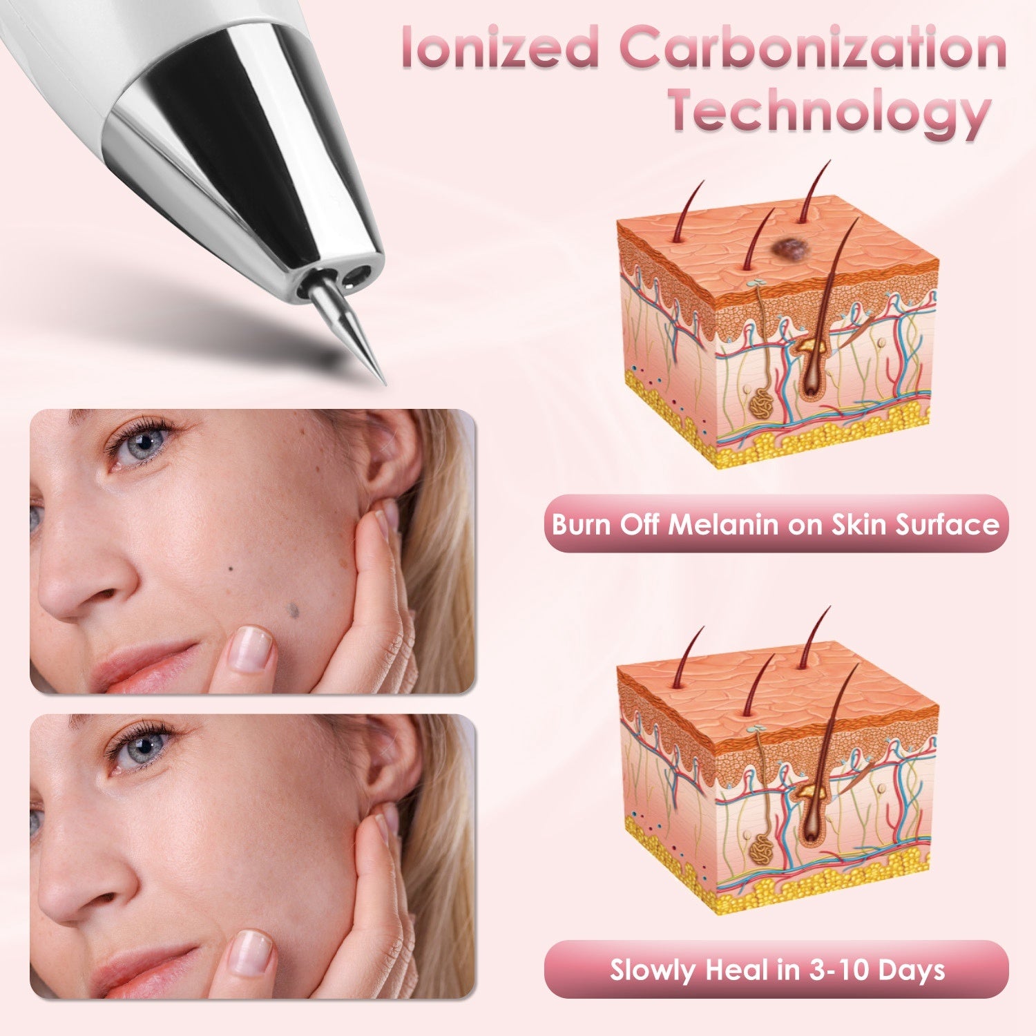 Skin Tag Remover Pen - Electric Spot Mole Wart Removal Tool with 9 Levels