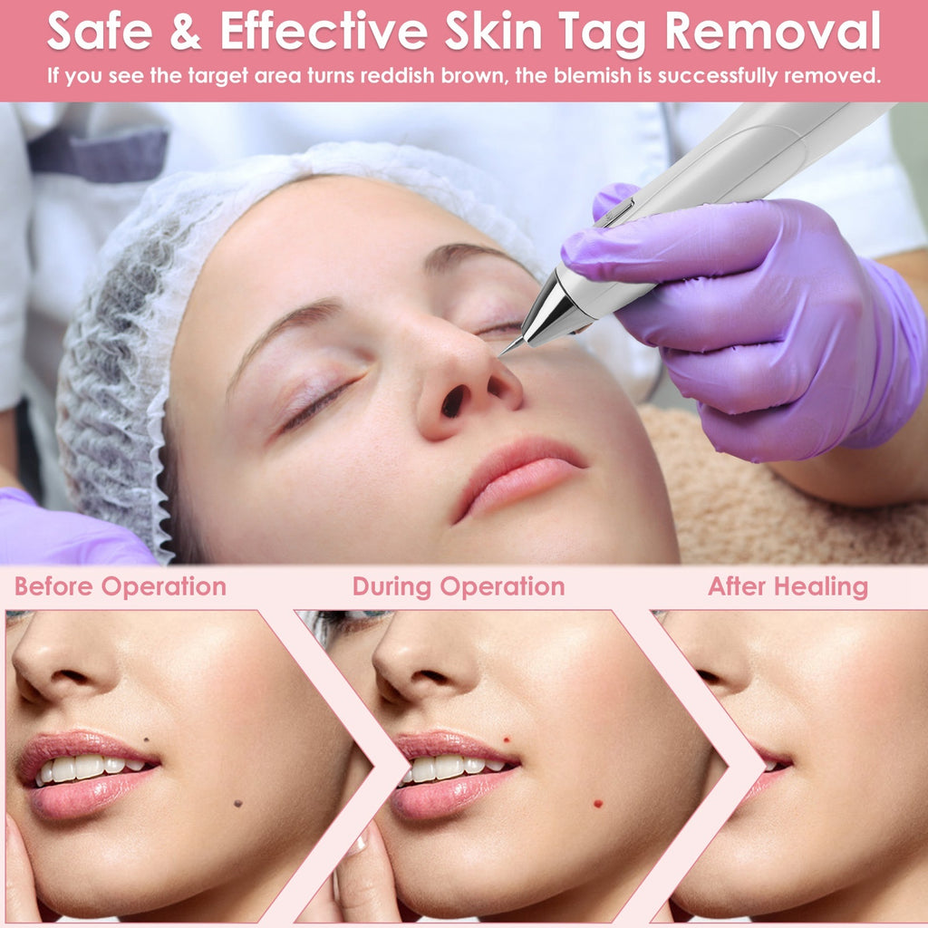 Skin Tag Remover Pen - Electric Spot Mole Wart Removal Tool with 9 Levels