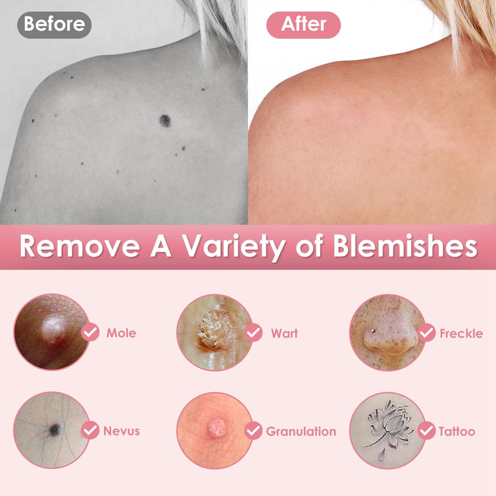 Skin Tag Remover Pen - Electric Spot Mole Wart Removal Tool with 9 Levels