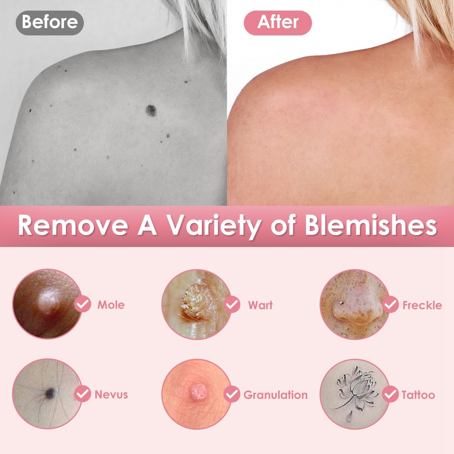 Skin Tag Remover Pen - Electric Spot Mole Wart Removal Tool with 9 Levels